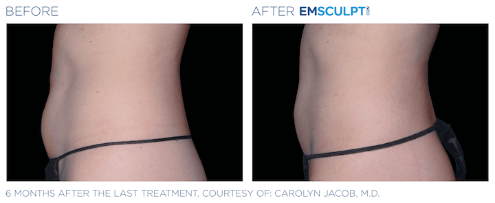 Emsculpt_neo before and after Sculpd+ Alexandria, VA 2