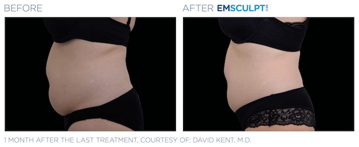 Emsculpt_neo before and after Sculpd+ Alexandria, VA 3