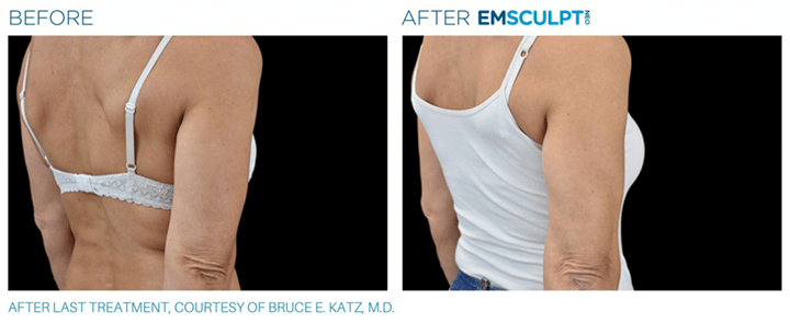 Emsculpt_neo-before-and-after-Sculpd+-Alexandria,-VA-4