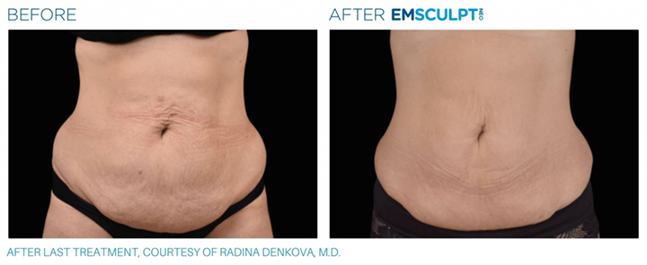 Emsculpt_neo-before-and-after-Sculpd+-Alexandria,-VA-5