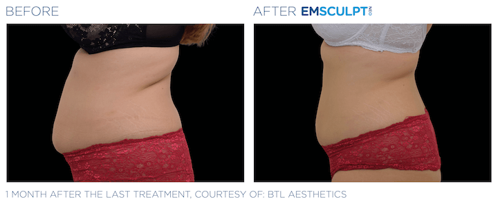 Emsculpt_neo before and after Sculpd+ Alexandria, VA