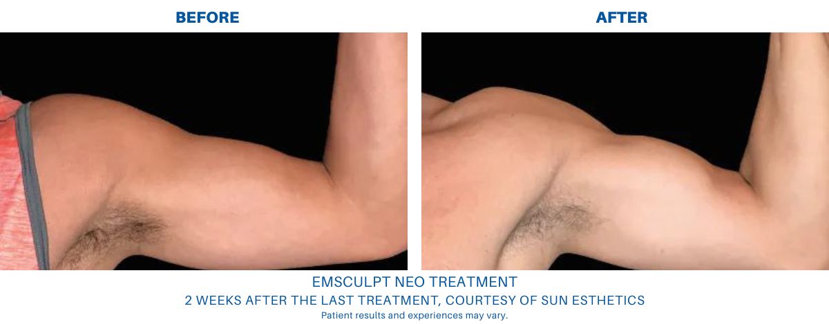 Emsculpt NEO treatment before and after image in Alexandria, VA