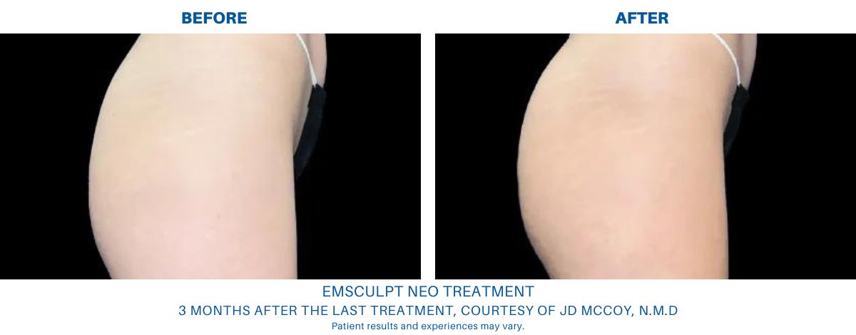 Before and after the result of an Emsculpt NEO treatment in Alexandria, VA