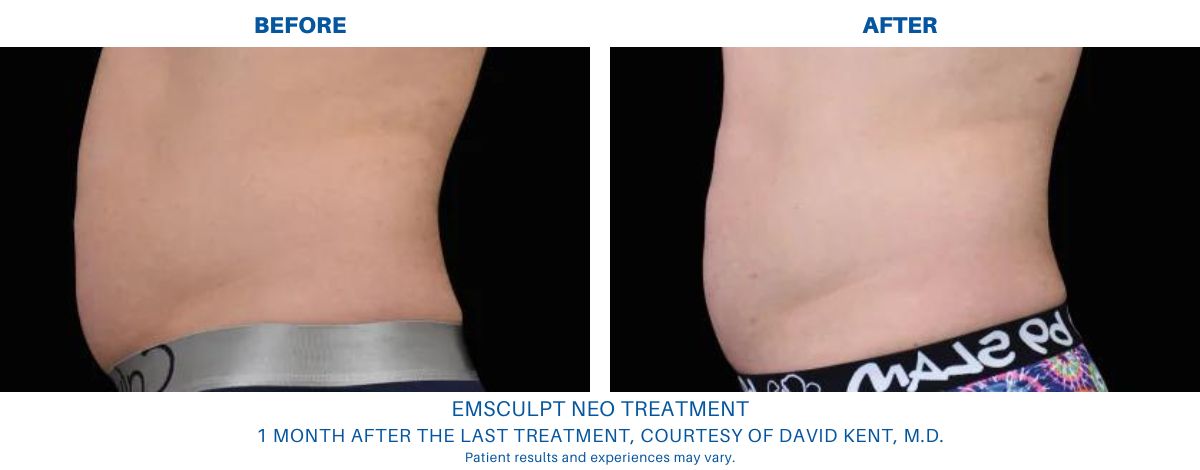 An Emsculpt NEO treatment before and after in Alexandria, VA