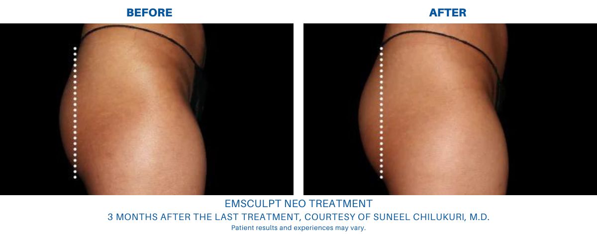 Before and after picture of an Emsculpt NEO treatment in Alexandria, VA