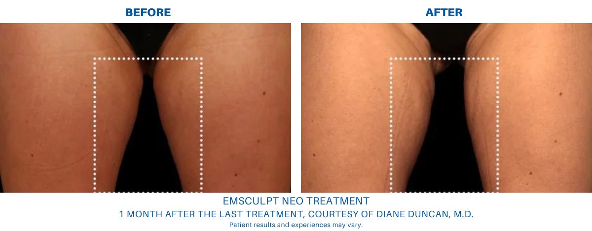 An image of Before and after Emsculpt NEO treatment results in Alexandria, VA