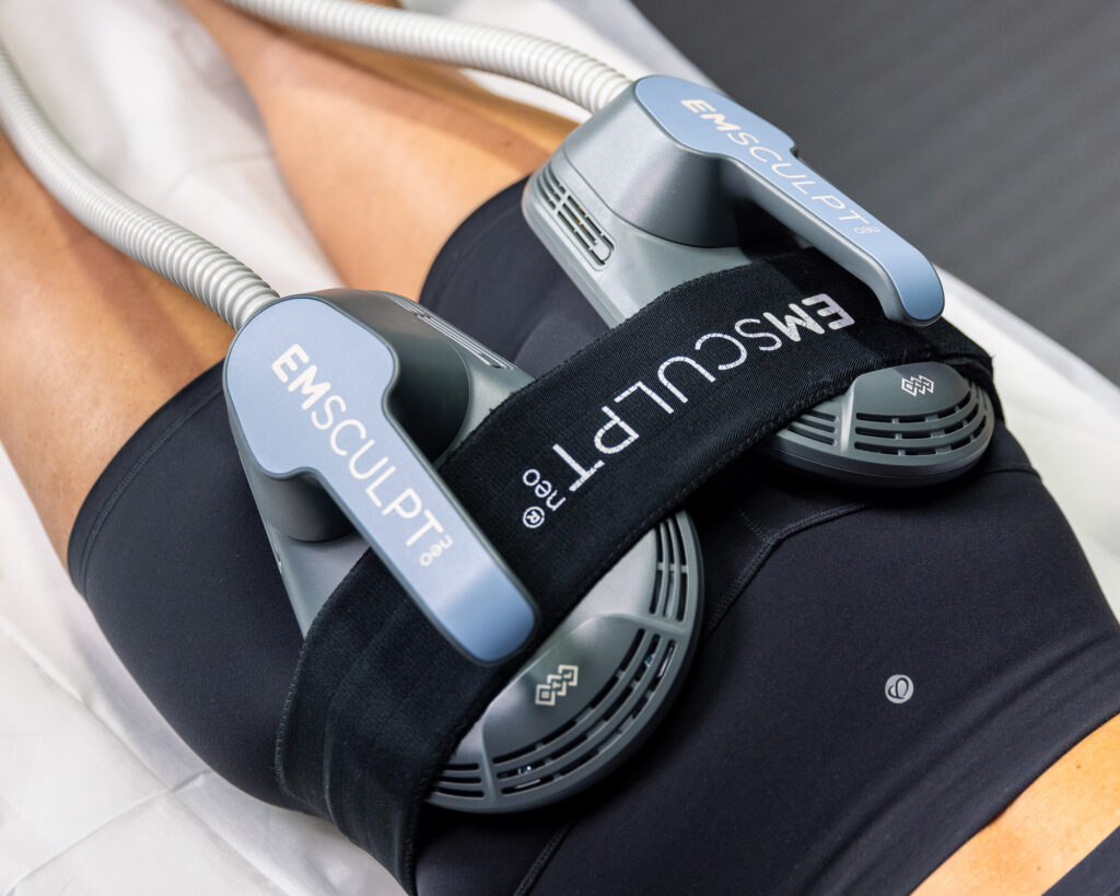 Close up of a muscle strengthening and fat burning medical treatment on a person's thighs using Emsculpt NEO near Arlington, VA at Sculp'd.
